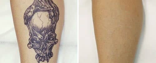 , Tattoo Removal