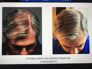 Hair Restoration, Hair Restoration