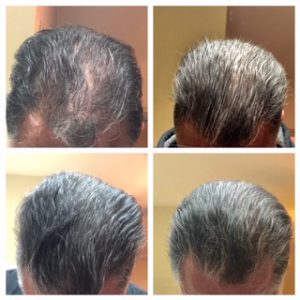 Hair Restoration, Hair Restoration